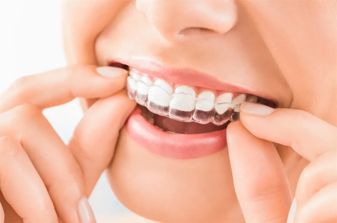 Aligneurs invisibles orthodontiste Saint-Germain-en-Laye