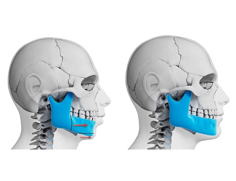 Chirurgie orthognatique Orthodontiste Saint-Germain-en-Laye